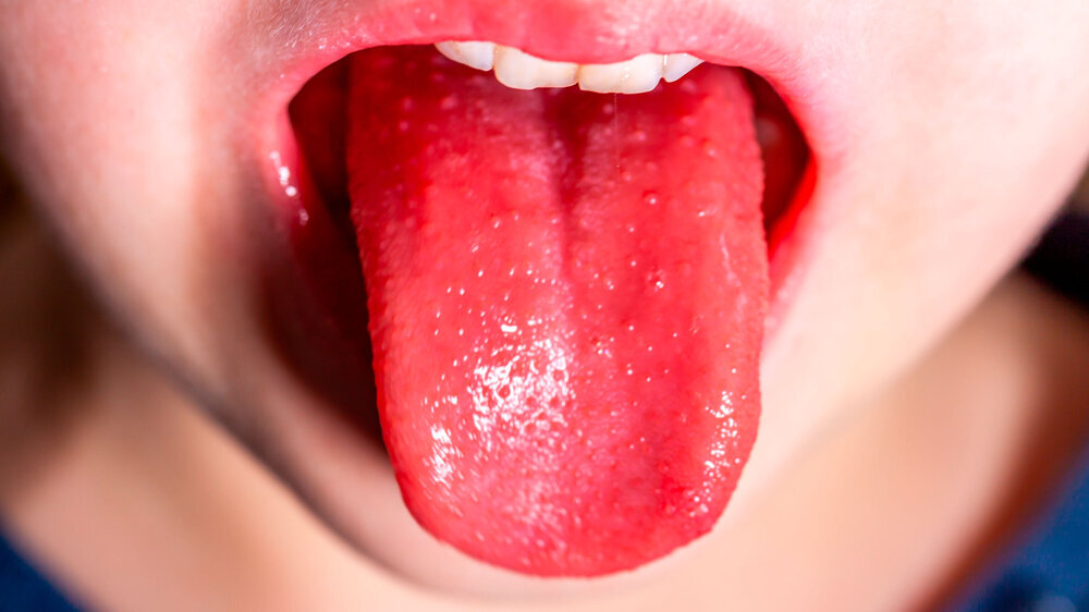Tongue of a child with scarlet fever - strawberry tongue Tongue of a child with scarlet fever - strawberry tongue.