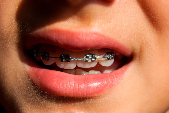 Nahaufnahme eines halb geöffneten Munds mit fester Zahnspange.