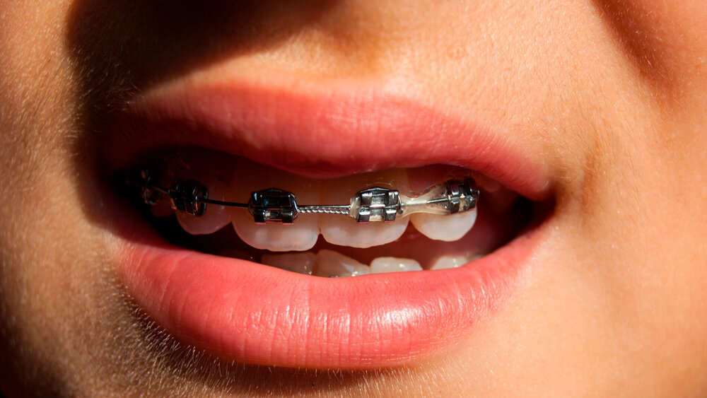 Nahaufnahme eines halb geöffneten Munds mit fester Zahnspange.