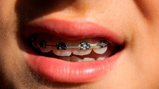 Nahaufnahme eines halb geöffneten Munds mit fester Zahnspange.