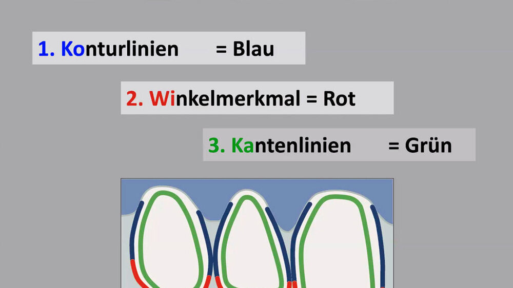 Wie lassen sich Frontzähne nach einem Trauma möglichst naturgetreu mit Komposit rehabilitieren? Zahnärztin Anne Bandel, Berlin, erläutert die Regeln der Formgebung anhand der natürlichen Zahnanatomie. Mesiale Winkel erscheinen da eher eckig, distale