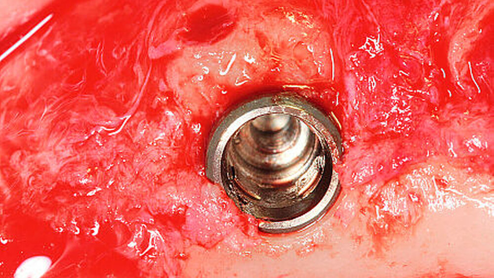 Abbildung 2b: Homogene Integration der Zahnwurzel im Defektbereich nach zwölf Wochen. Erkennbar sind deutliche klinische Merkmale einer Ersatzresorption. |