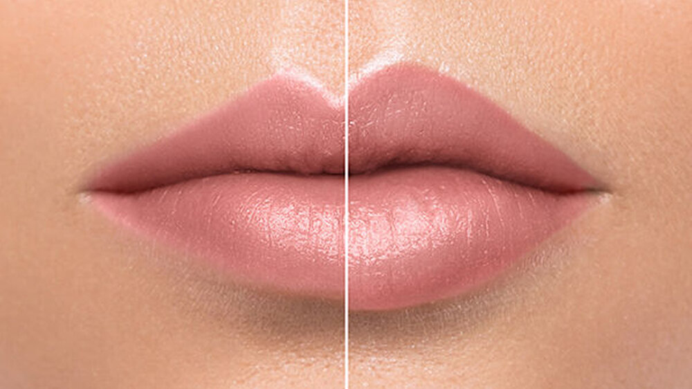 Lippenvergrößerungen werden dann als attraktiv wahrgenommen, wenn das Verhältnis Oberlippe-Unterlippe im Ergebnis dem Goldenen Schnitt entspricht. Aufgeblasene Lippen findet die Mehrheit nicht schön.