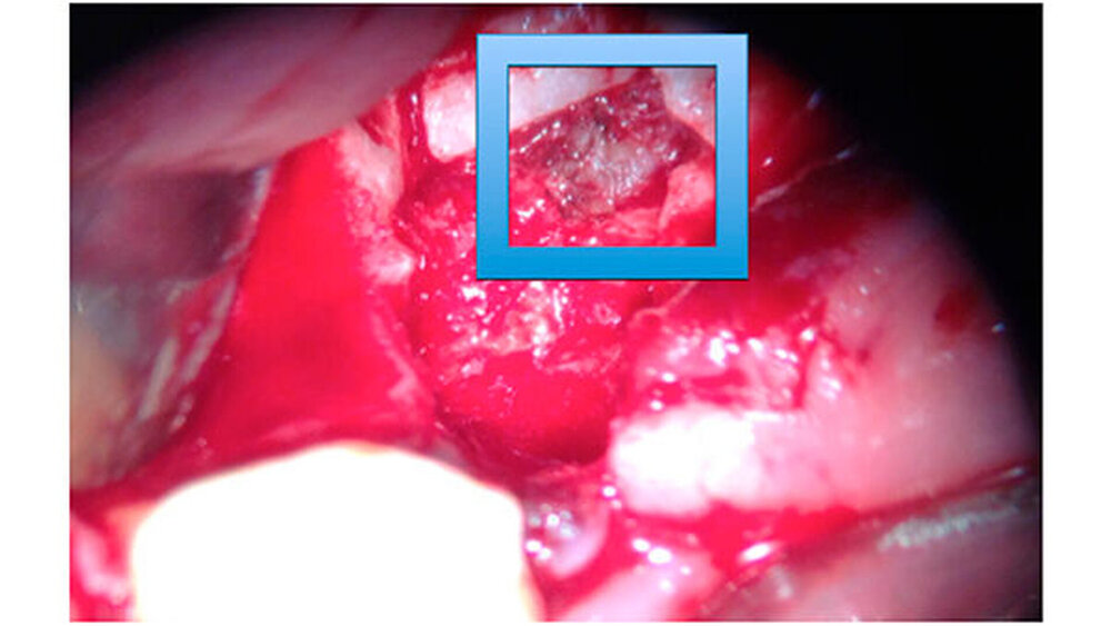 Abbildung 6: Intraoperative Aufnahme des freiliegenden Nervus alveolaris inferior regio 47 (blaue Markierung), aus dem die Reste des Füllmaterials entfernt wurden und der anschließend mikrochirurgisch rekonstruiert und mit einer Kollagenmembran umschlossen wurde. |