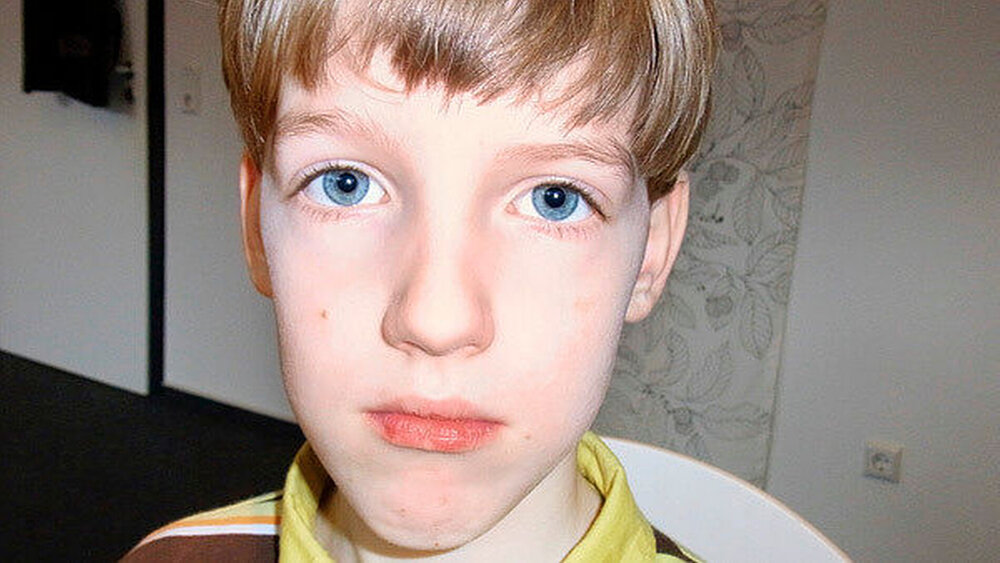Fall 2: Dieser neunjährige Junge kam mit hohem, schmalem Gaumen, unphysiologischer Zungenruhelage und unphysiologischem Schluckbewegungsmuster zur Myofunktionstherapie in die Praxis. \r\nAbbildung 5: Auffällig ist außerdem eine eingeschränkte skelettale Mittelgesichtsentwicklung. |