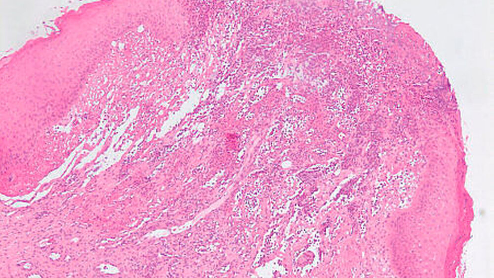 Abbildung 2: Histologischer Befund: chronische Entzündungsreaktion (Entzündungszellen und multiple dünnwandige Gefäße mit Fibroblasteneinsprossungen) mit reaktiver Veränderung des bedeckenden Epithels |