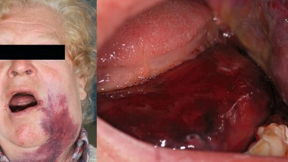 Abbildung 5: Bei diesem Patienten wurde bei einem progredienten Mundbodenhämatom nach alio loco durchgeführter Osteotomie der Zähne 38 und 37 unter Markumarmedikation wegen Stent-Implantation ebenfalls eine temporäre Tracheotomie notwendig. |