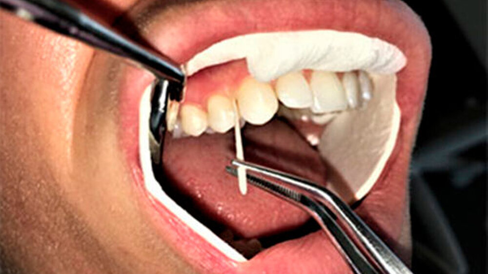 Einem Probanden wird eine Probe oraler Bakterien entnommen. Das Wissen um die unterschiedlichen Entzündungsreaktionen bei Gingivitis könnte helfen, Menschen mit erhöhtem Parodontitisrisiko besser zu identifizieren.