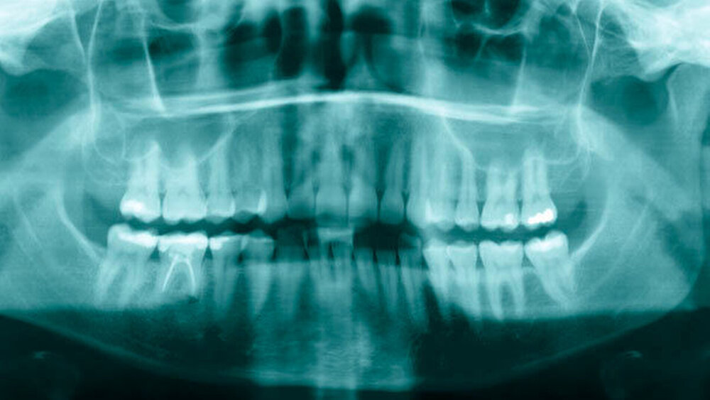 Abbildung 1: Orthopantomogramm mit einer sichtbaren okklusalen Füllung am Zahn 37 |