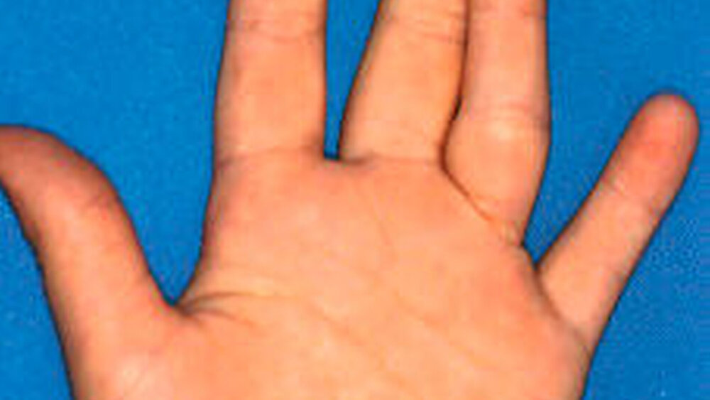 Abbildung 2: Durch Lutschen beeinflusste Verkrümmung des Ringfingers |