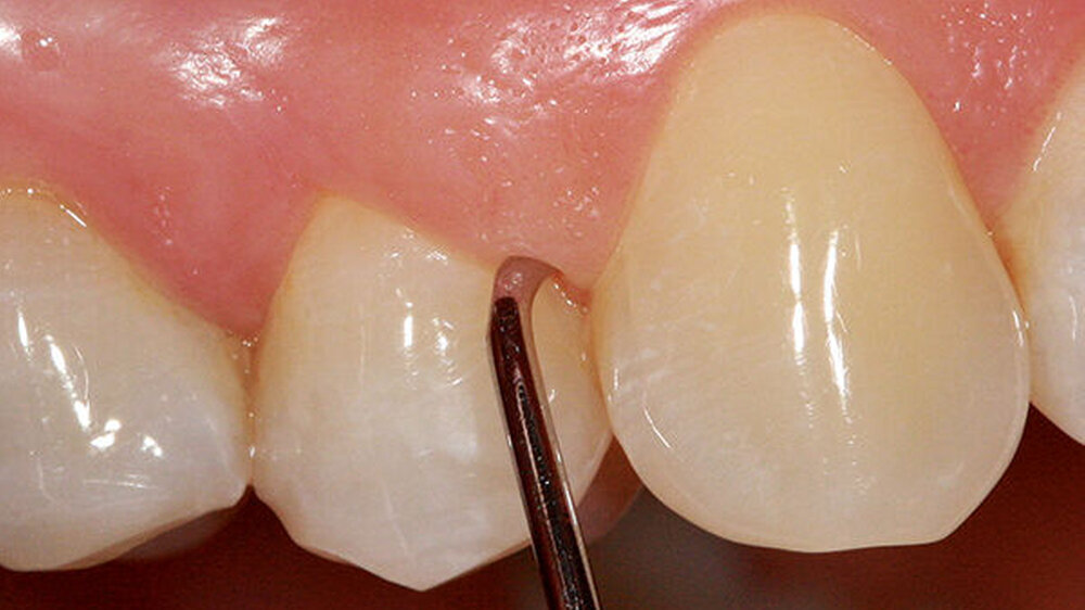 Subgingivale Instrumentierung mittels Handinstrument (Gracey-Kürette)