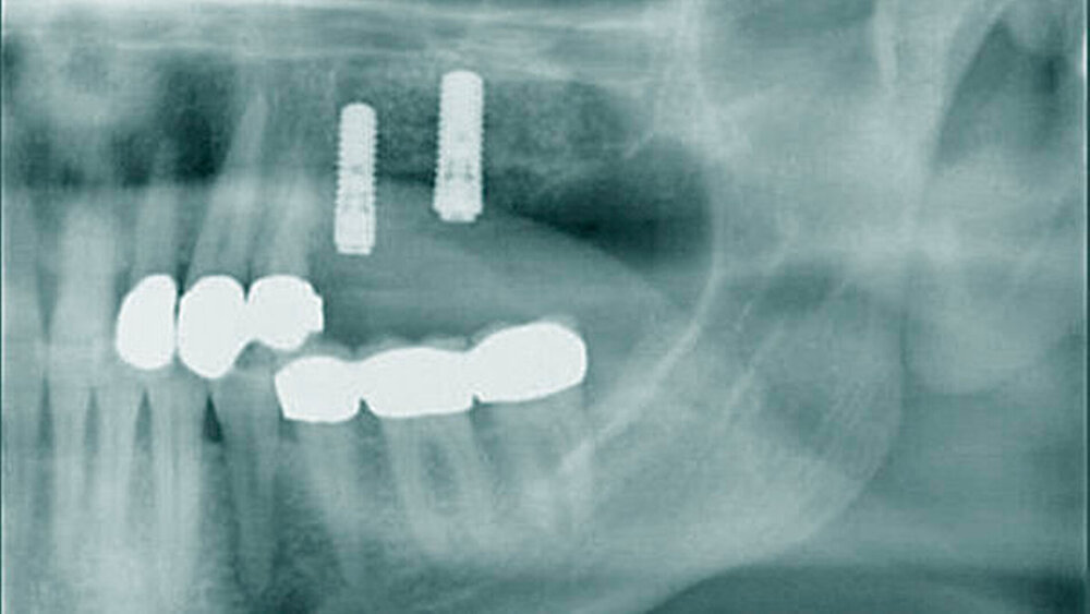 Augmentationsverfahren wie der Sinuslift mit Einlagerungsosteoplastik lassen sich auch bei Patienten mit gut eingestelltem Diabetes mellitus sicher durchführen. |