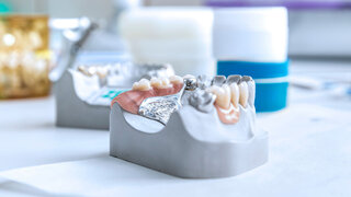 Zahnersatz, Brücke auf einem Gebissabdruck aus Gips liegt bereit.