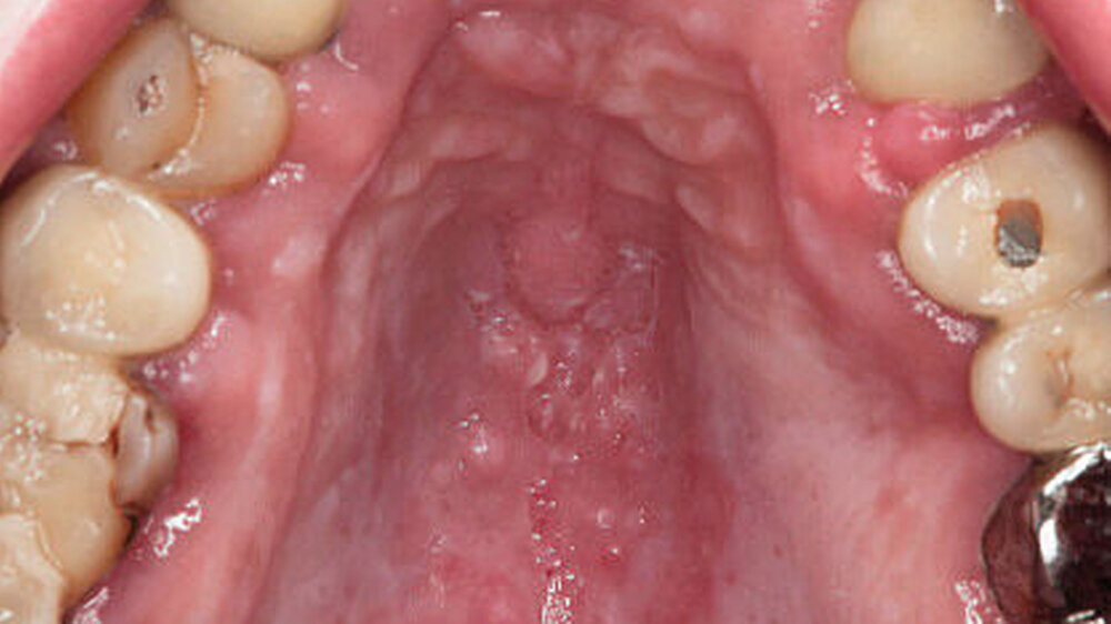 Abbildung 3: Erythematöse Candidiasis am Gaumen eines HIVpositiven Patienten ohne antiretrovirale Therapie (Patient männlich, 49 Jahre) |