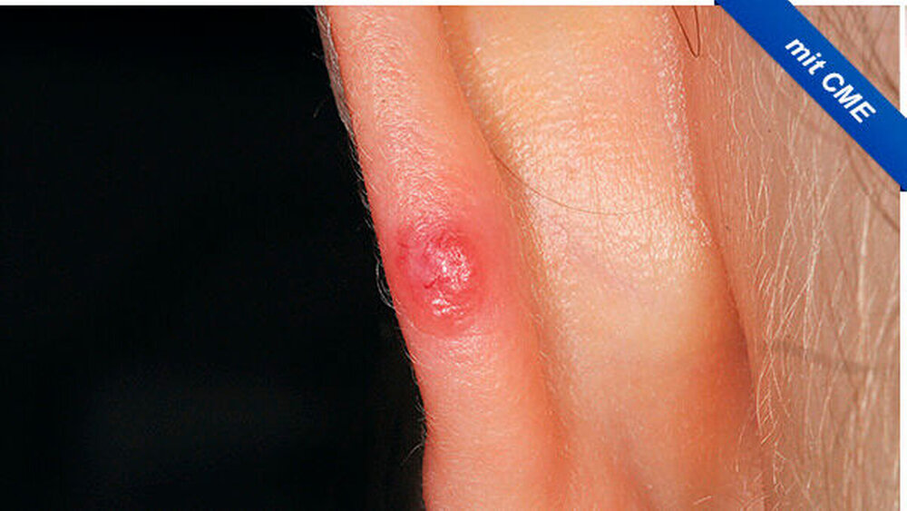 Abbildung 1: Klinischer Befund mit einer kreisrunden 3 bis 4 mm großen, erhabenen, rötlich veränderten Raumforderung an der Helix des linken Ohres |