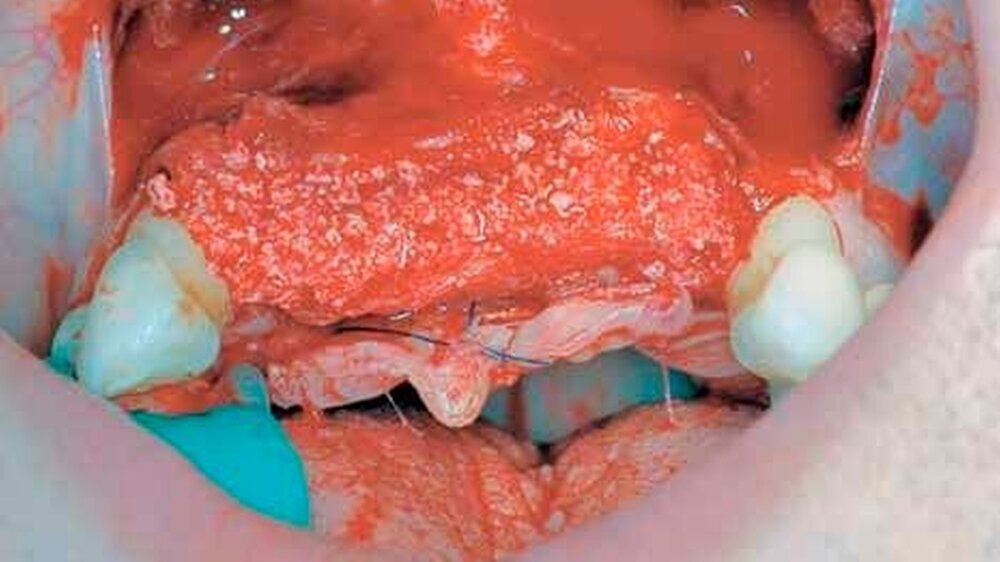 Abbildung 1: GBR-Technik – präimplantäre Alveolarkammaugmentation: Nachdem eine ausreichende Knochenaufdehnung realisiert war, wurde der Spalt mit anorganischem Knochenersatzmaterial bovinen Ursprungs aufgefüllt. Die Wunde wurde anschließend zweisch
