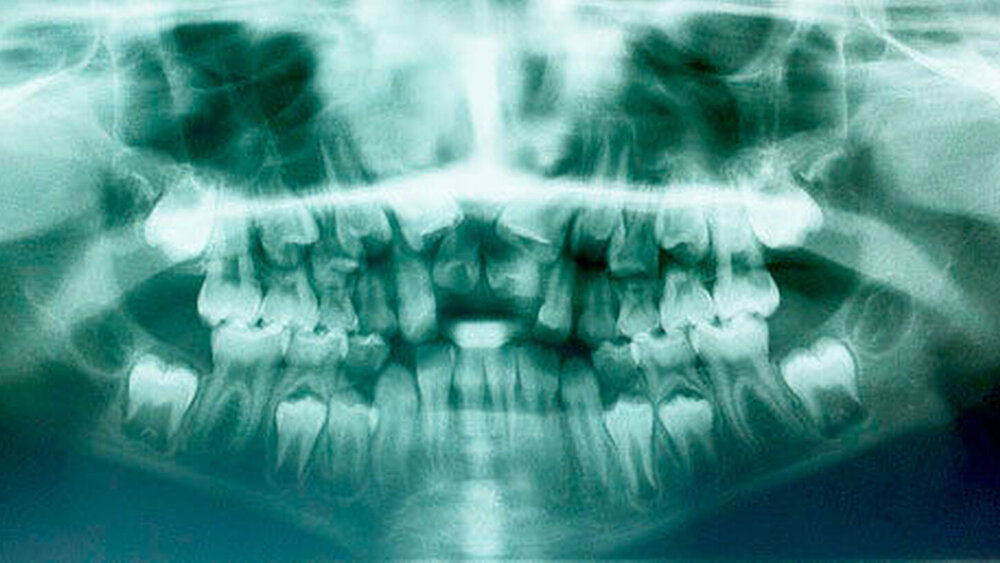 Abbildungen 13 bis 15: Behinderung und deutliche Verzögerung der normalen Eruption der zentralen Inzisiven im Oberkiefer aufgrund überzähliger Zähne (11+ und 21+) bei einer knapp neunjährigen Patientin (13: Panoramaschichtaufnahme). |
