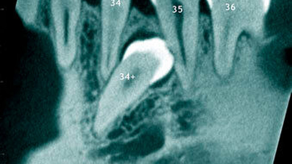 Abbildung 18: Überzähliger Zahn (34+) im Prämolarenbereich des linken Unterkiefers mit radiologisch erkennbarer Wurzelresorption mesial beim Zahn 35 bei einem 39-jährigen Patienten (a: sagittales Schnittbild der digitalen Volumentomografie). |