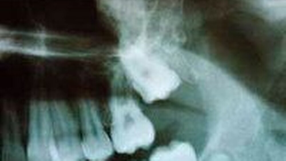 Abbildung 1: Das Orthopantomogramm zeigt eine wolkige, unregelmäßig begrenzte, inhomogene Verschattung distal und cranial des retinierten 27.
