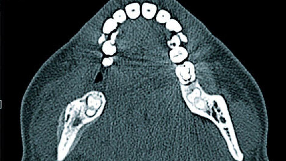 Abbildung 7: Computertomografie einer Patientin mit SAPHO-Syndrom: Deutliche Sklerosierung der Spongiosa rechts mit periostaler Osteoid- und Knochenneubildung. Die Patientin hatte in dieser Kieferregion eine ausgeprägte Schmerzsymptomatik. |