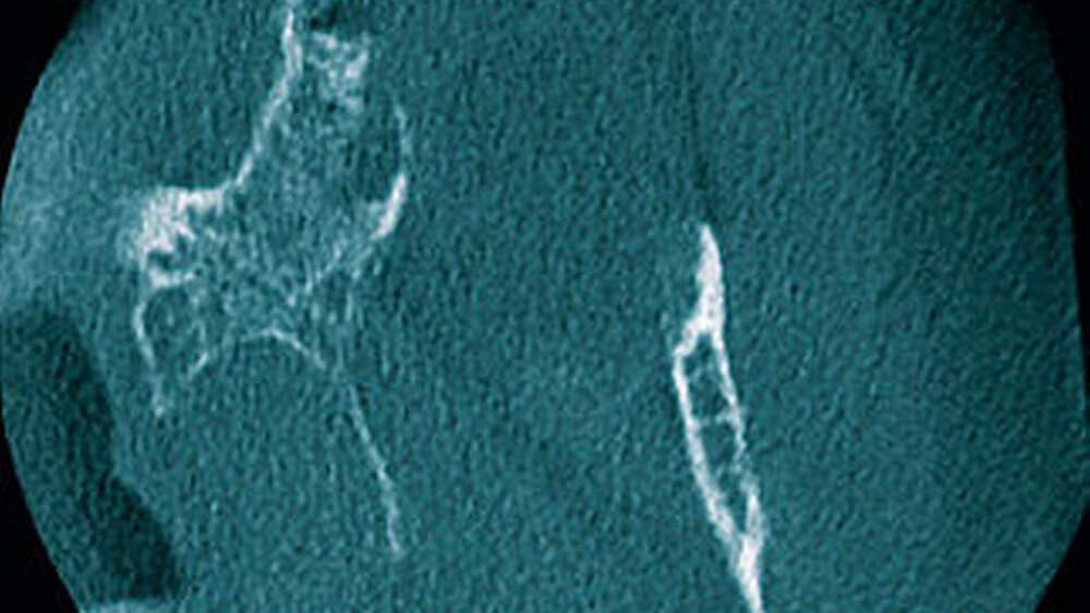 Abbildung 3: Ausschnitte der digitalen Volumentomografie in axialer (3a), ... |