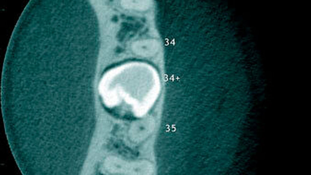 Abbildung 18: Überzähliger Zahn (34+) im Prämolarenbereich des linken Unterkiefers mit radiologisch erkennbarer Wurzelresorption mesial beim Zahn 35 bei einem 39-jährigen Patienten (b: axialer Schnitt). |