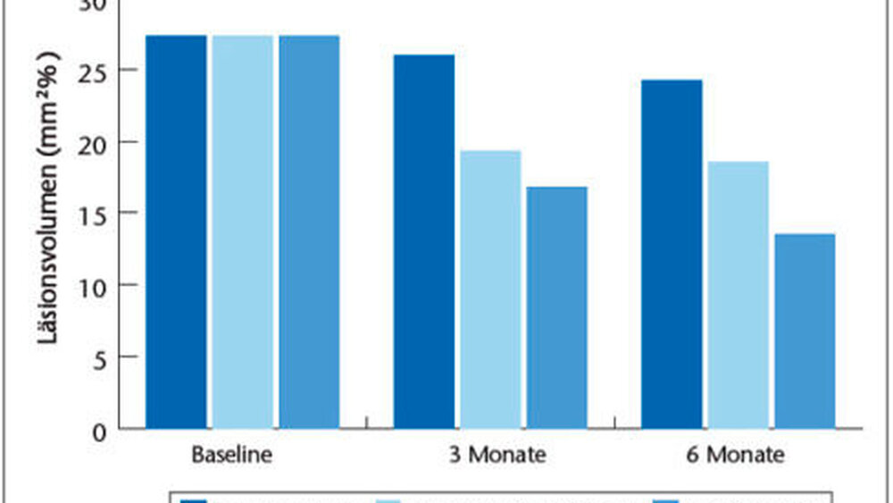 Abbildung 4: Läsionsvolumen initialkariöser Läsionen zu Beginn, nach drei Monaten und am Ende einer klinischen Studie, in der unterschiedliche Zahnpastaformulierungen verwendet wurden. |