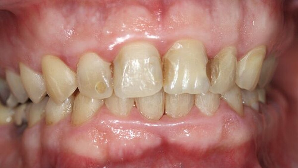 Abbildung 2b: Orthodontische Multibandbehandlung zur Bisshebung und zur dentalen Abstützung der Schneidezähne. |