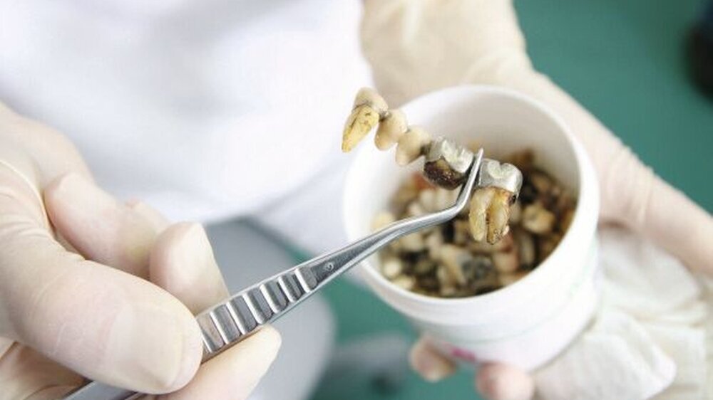 Das Zahngold ist den Patienten auszuhändigen; einige von ihnen lassen es dann einschmelzen und verwenden es als Basis für ein Schmuckstück.