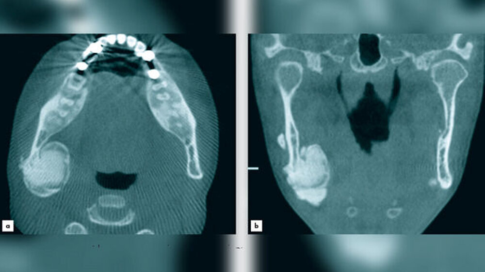 Abb. 1: a: CT in axialer Ansicht mit typischem Wechsel von hyp- und hyperostotischen Bereichen mit homogenen, milchglasfensterartigen Zonen b: Das CT in coronaler Ansicht zeigt den Befund in einer Ausdehnung von 30 mm x 23 mm. Man erkennt den typischen We