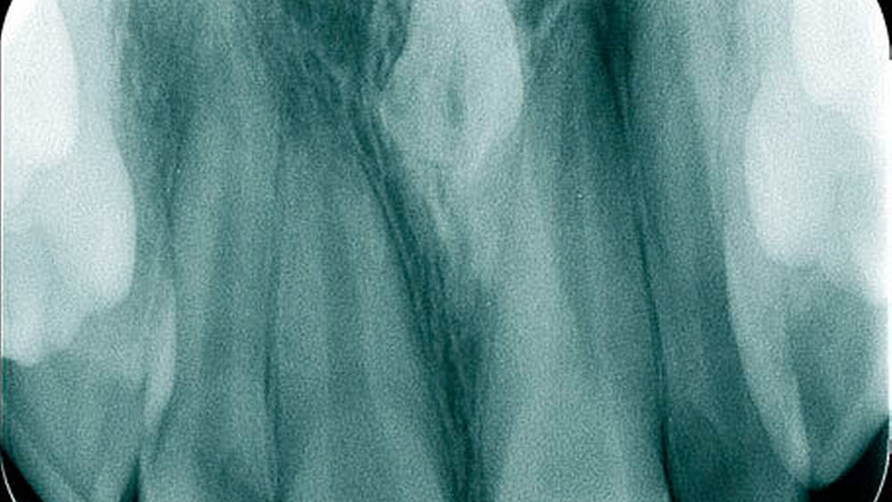 Abbildungen 6: Mesiodens bei einem 14-jährigen Patienten, welcher als radiologischer Zufallsbefund vor kieferorthopädischer Behandlung diagnostiziert wurde ( Aufbissröntgenbild). |