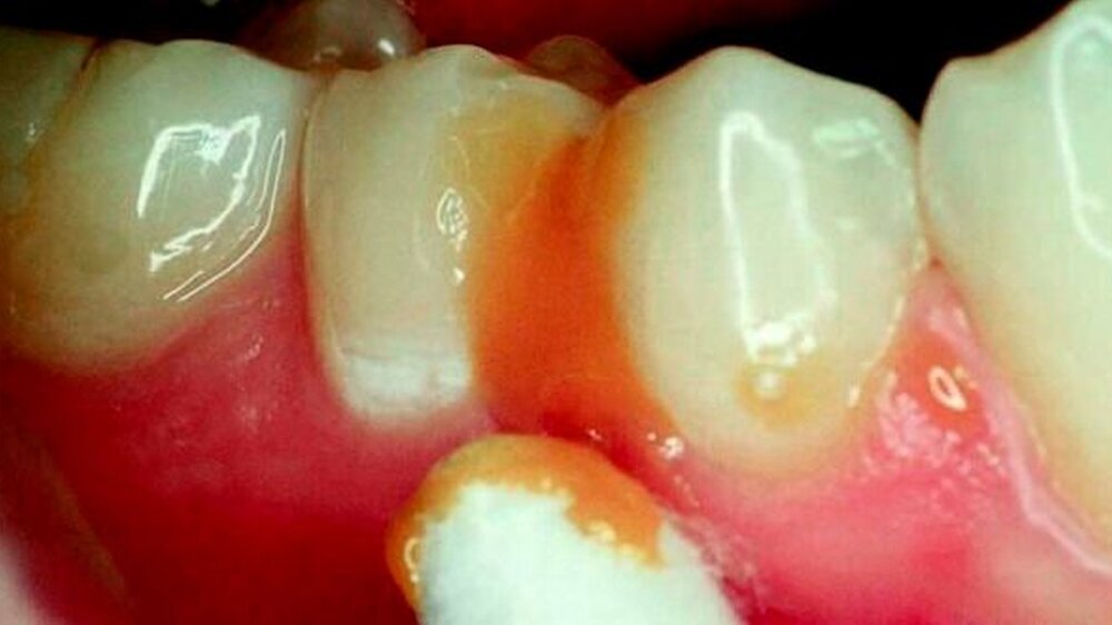 Nach Untersuchungen von Zimmer et al. führt bereits die zweimal jährliche Applikation eines hoch konzentrierten Fluoridlackes auch bei Kindern mit erhöhtem Kariesrisiko zu einer Karieshemmung von durchschnittlich 37 Prozent.