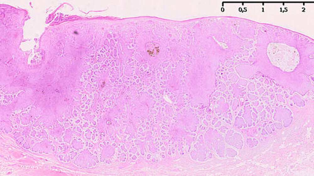 Abbildung 2: In der HE-Färbung ist an der Oberfläche eine ausgedünnte plattenepitheliale Epidermis mit einem basaloid differenzierten Proliferat nodulären Aufbaus zu erkennen. |