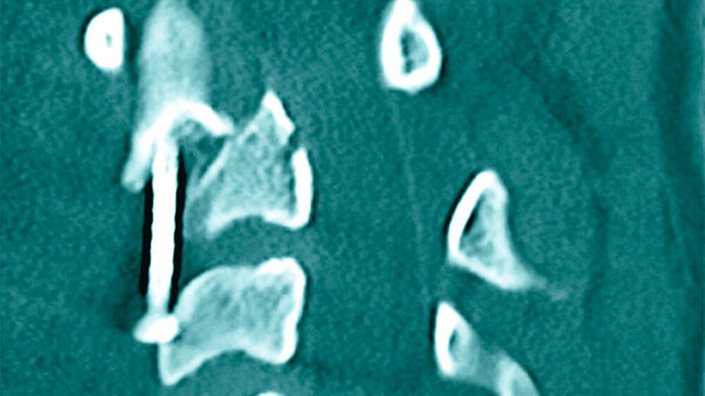 03.07.2016: Die postoperative CT-Kontrolle der ersten durchgeführten Osteosynthese zeigte einen Ausriss der Osteosyntheseschraube aus dem basalen Fragment des Axis. |