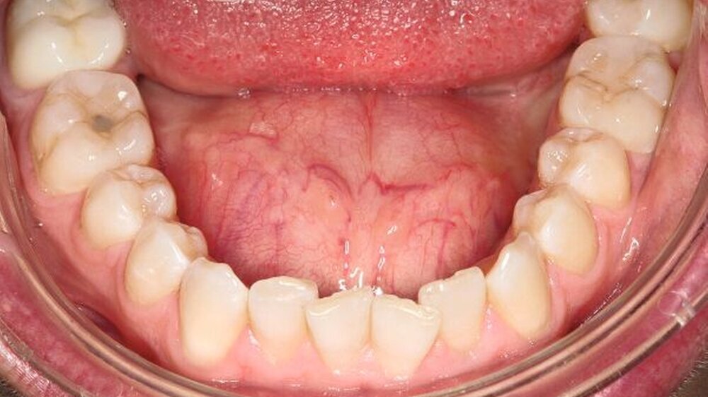 Abbildung 1: klinisches Bild bei Erstvorstellung: prall elastische, kugelige Vorwölbung der ansonsten unauffälligen Mundbodenschleimhau