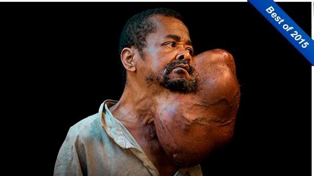 Sambany vor der OP mit einem 7.46 Kilogramm schweren Tumor.