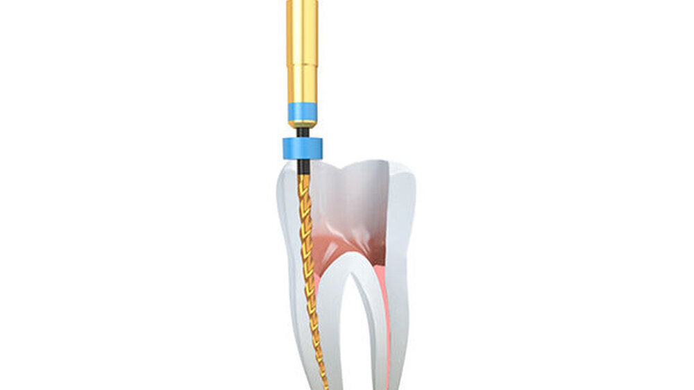 Mit speziellen Revisionsfeilen erweitert der international führende Dentalspezialist COLTENE aktuell sein Sortiment hochflexibler Nickel-Titan-Feilen.