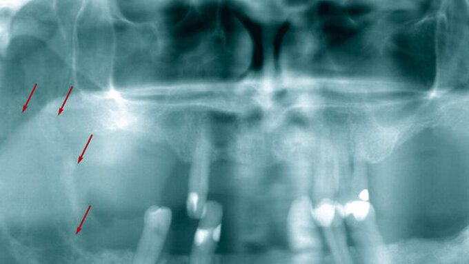 Abb. 1: Panoramaschichtaufnahme mit osteolytischer inhomogener Raumforderung im Beyureich des rechten Kieferwinkels (rote Pfeile): Es fällt ein unscharfer Rand auf. Nebenbefundlich zeigte sich eine rundliche osteolytische Raumforderung apikal an Zahn 13.