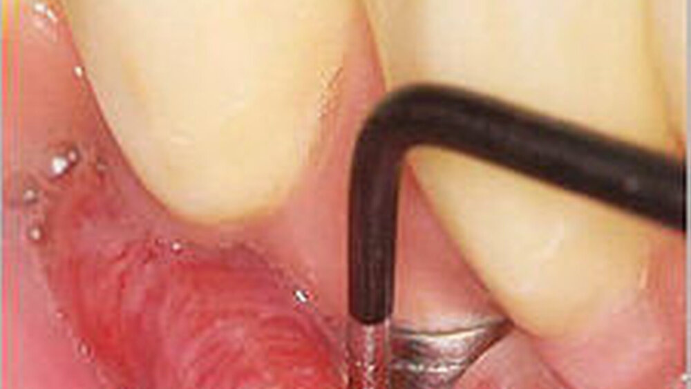 Das Risiko für periimplantäre Entzündungen steigt mit der Dauer bei Diabetikern an. |