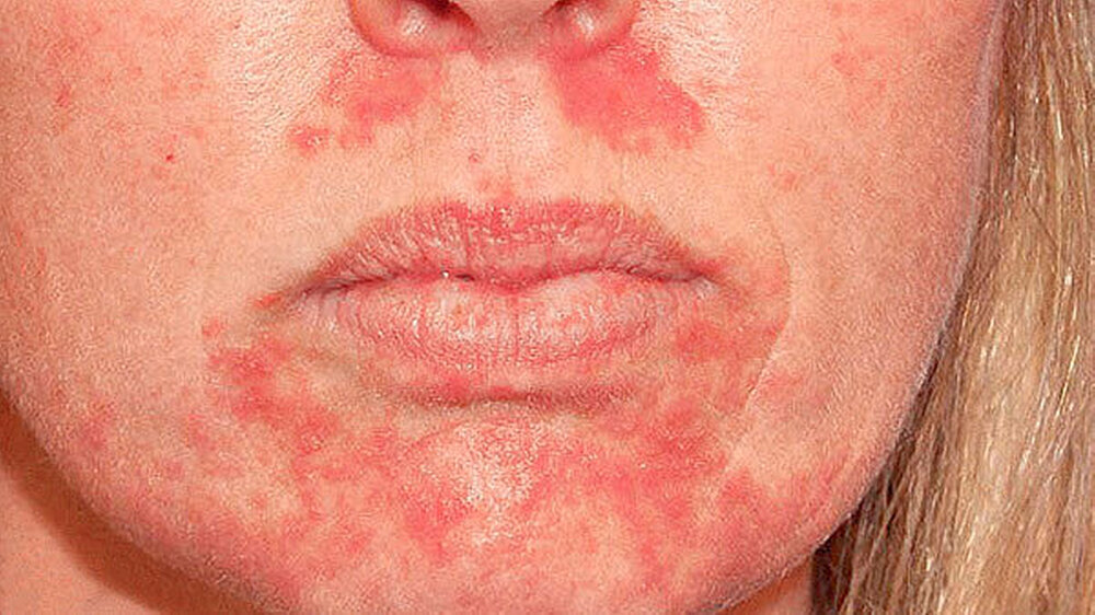 Abbildung 2: Periorale Dermatitis nach Applikation eines Keramik-Inlays mit einem Adhäsiv (b). |