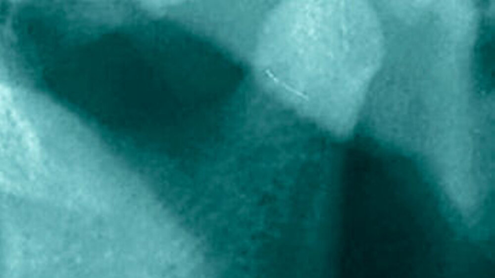 Abbildung 1 c: Größen- und Formveränderung des rechten Kondylus sowie abgeflachte Fossa, links ist der Kondylus unversehrt. |