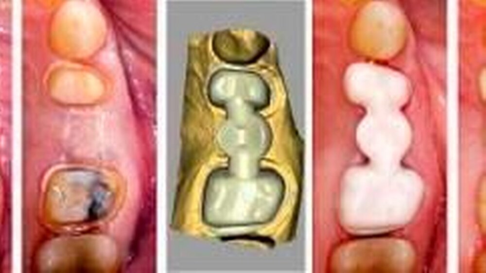 Abbildung 4: a) Lückensituation, b) zirkuläre Stufenpräparation, c) inLab 3D Gerüstkonstruktion, d) IPS e.max ZirCAD Gerüst, e) mit Panavia zementierte Brücke. Behandung Dr. D. Wolf, Station für Zahnfarbene Computerrestaurationen, Abteilung für Pr
