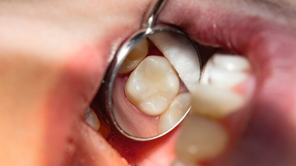 two chewing side teeth of the upper jaw after treatment of caries. Restoration of the chewing surface with a photopolymer filling material using the Rubber Dam system
