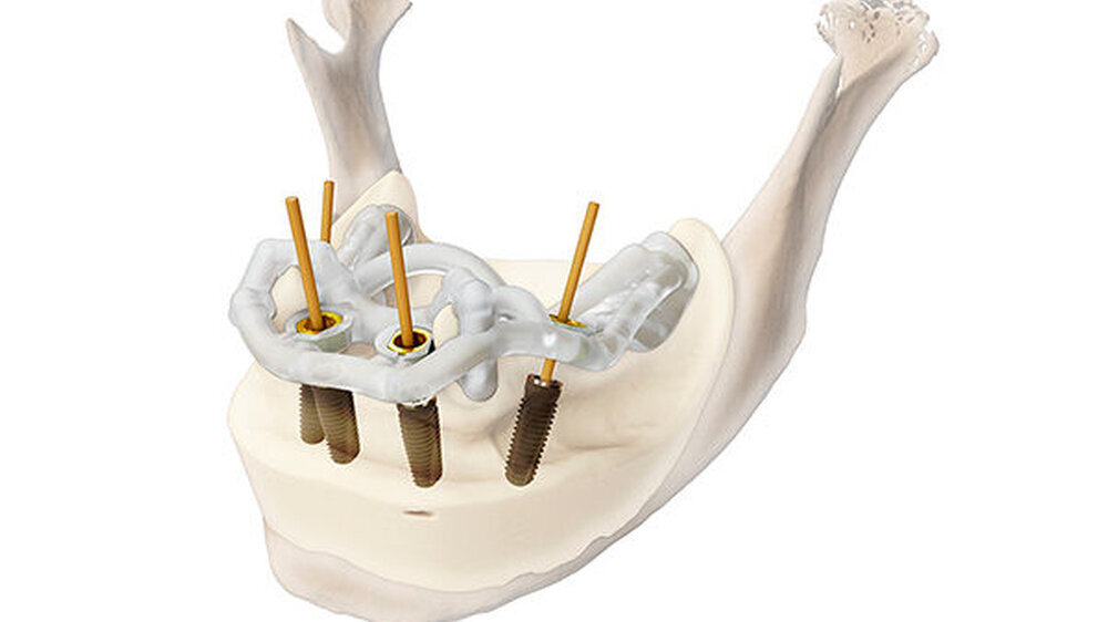 Jeder Kunde entscheidet selbst, welche Arbeitsschritte er in Eigenregie ausführt. Bohrschablonen kann er beispielsweise auf Wunsch auch auf dem eigenen 3D-Drucker fertigen.