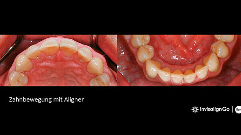 Situation nach Abschluss der Aligner-Therapie in der Aufsicht. Deutlich zu erkennen sind die ästhetisch und funktionell gut ausgeformten Zahnbögen nach dem wöchentlichen Wechsel der Schienen