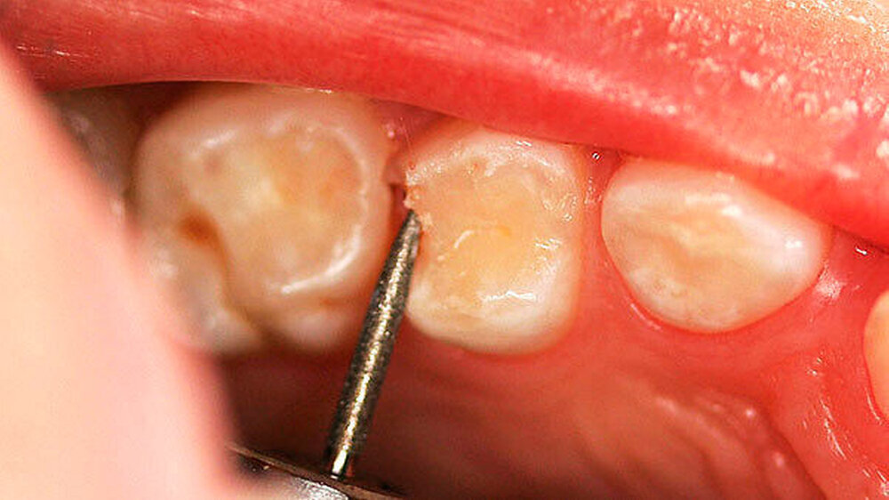 Abbildung 1: Die Eröffnung der approximalen Kariesläsion kann durch Entfernung des überhängenden Zahnschmelzes mit rotierenden Instrumenten erfolgen, wie beispielhaft an Zahn 54 distal dargestellt.