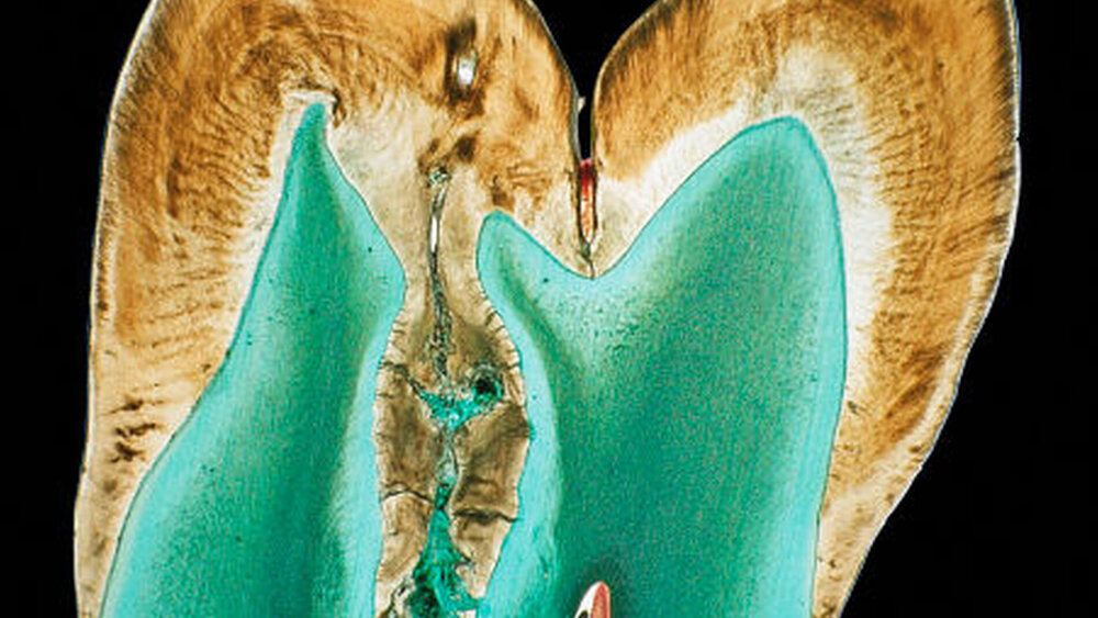 Abbildungen 5a und 5b: Schnitt durch die Vertikalebene eines Molaren mit einer Schmelzinvagination, die von der Höckerspitze ausging (a): In der Vergrößerung sind irreguläre Schmelz- und Dentinstrukturen am Boden der Invagination zu erkennen (b). |