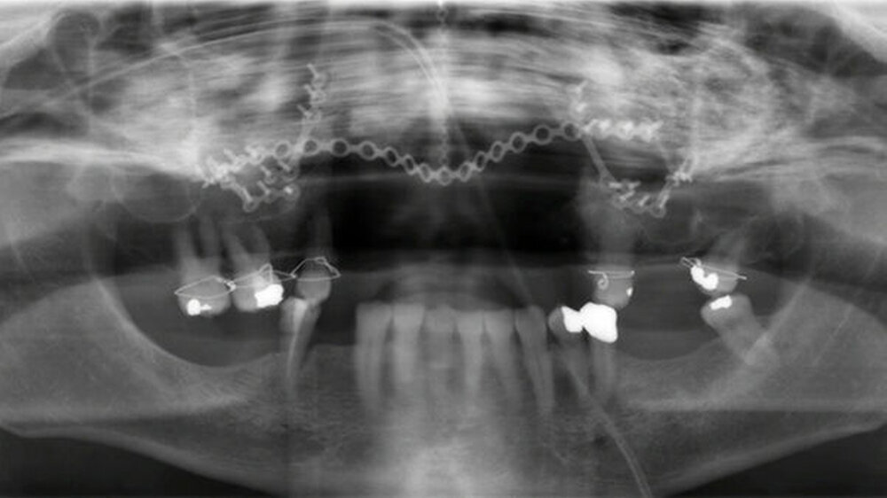 Abbildung 6: OPG Kontrolle: korrekter Sitz des Osteosynthesematerials in Projektion auf beide Kieferhöhlen