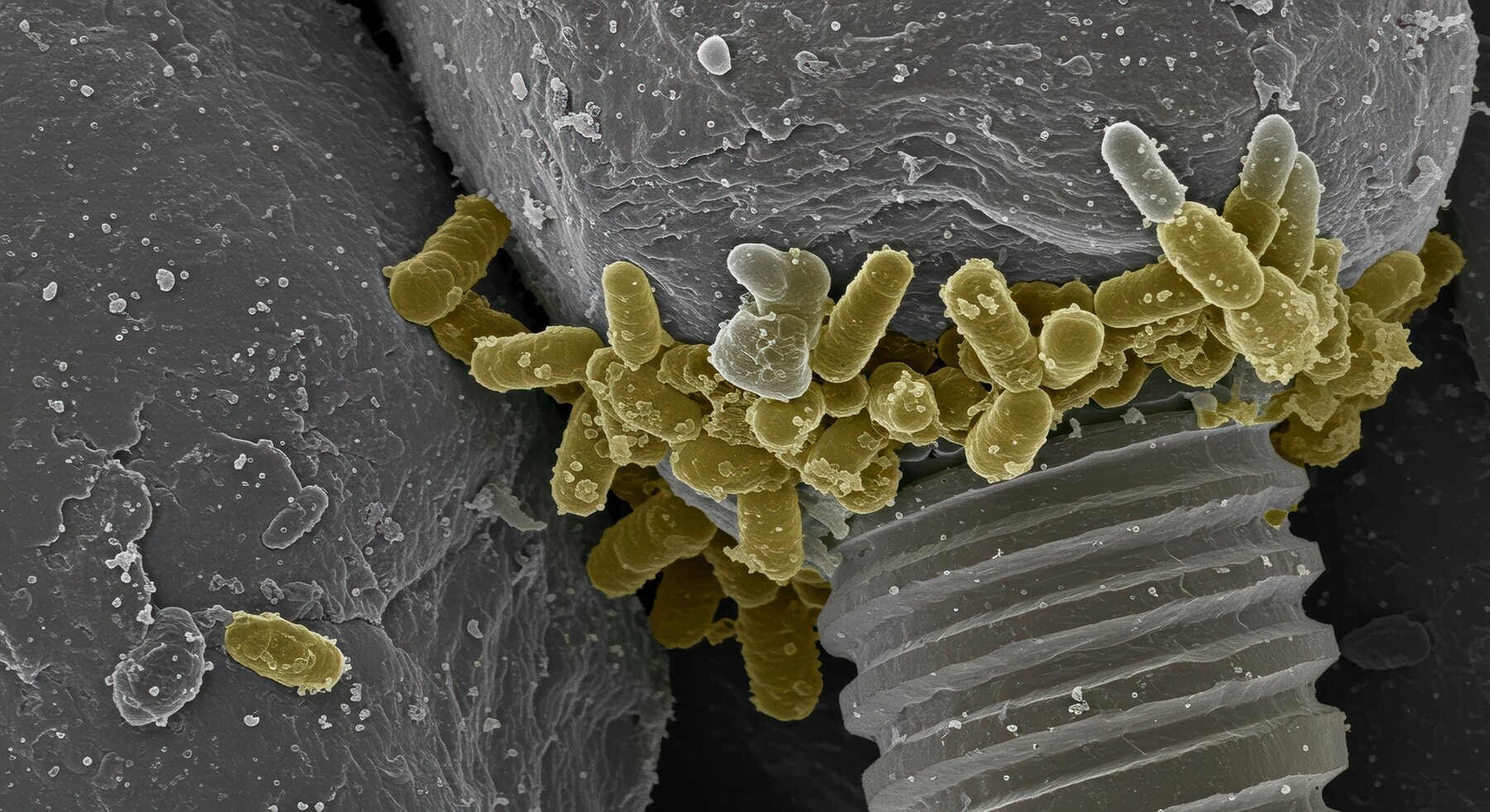 Periimplantitis