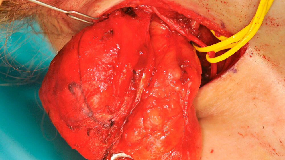 Entfernung des Tumors in toto